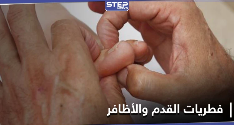 لإيقاف خطر الإصابة بمرض فطريات القدم والأظافر.. إليك 7 نصائح لمكافحته