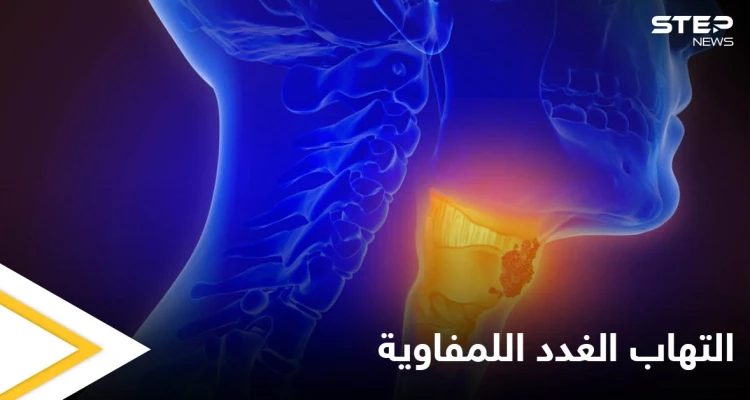 أسباب التهاب الغدد اللمفاوية و أهم طرق علاجها في المنزل