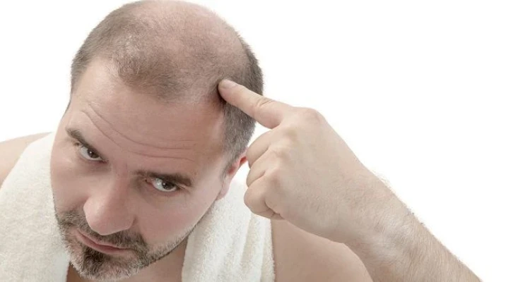 5 أسباب رئيسية تؤدي إلى تساقط الشعر