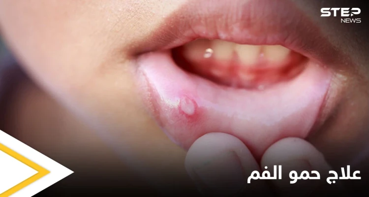 ما هي أسباب ظهور حمو الفم ومتى يكون خطيراً ويحتاج إلى التدخل الطبي إليك أهم المعلومات