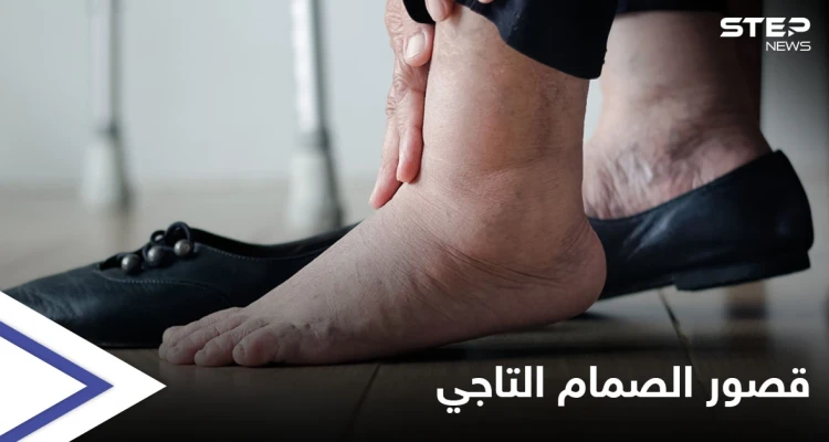 منها تورم القدمين.. تعرف على أعراض قصور الصمام التاجي وأسبابه وطرق العلاج