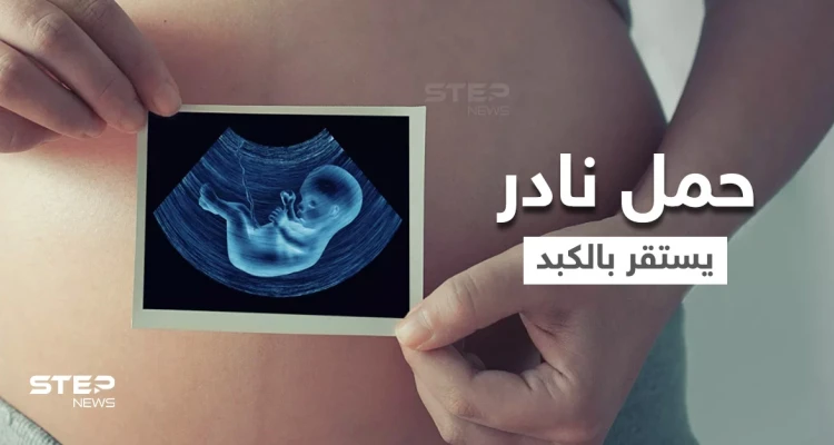 بالفيديو|| بحالة فريدة من نوعها في العالم.. حمل نادر لامرأة خارج الرحم استقر في الكبد