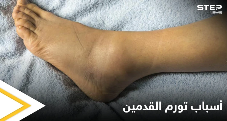 تعرف على أسباب تورم القدمين عند الرجال الأمراض المرتبطة بها