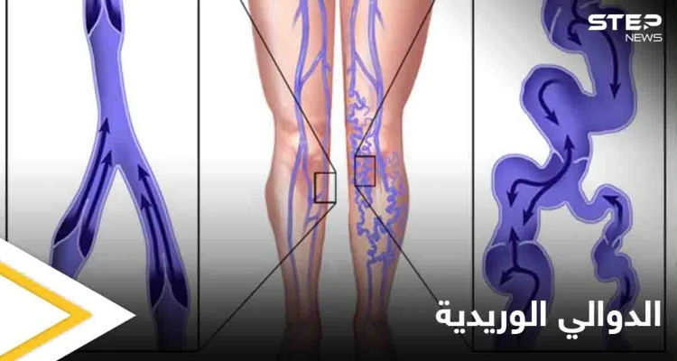 يسبب الكثير من الأعراض المزعجة.. تعرف على مرض الدوالي الوريدية وأسبابه وطرق الوقاية منه: أخبار