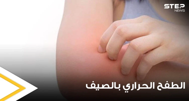 الطفح الحراري في الصيف أعراضه وأسبابه وطرق علاجه