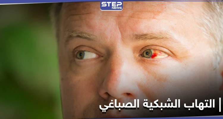 أخطر الإصابات العينية.. التهاب الشبكية الصباغي تعرّف إلى أعراضه وعلاجاته
