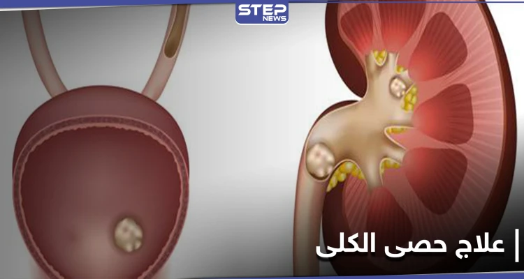 ما لا تعرفه عن حصى الكلى وكيف يمكن معالجتها بالوسائل المنزلية البسيطة