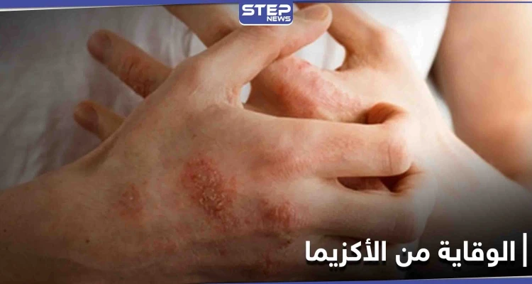 ماهي الأكزيما.. أسباب حدوثها وأهم الطرق للوقاية منها