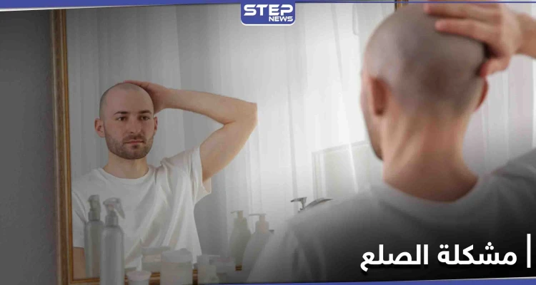 إذا كنت تعاني من مشكلة الصلع.. علماء يكتشفون حلاً بسيطاً لها