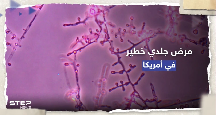 معدي ومقاوم للأدوية.. تسجيل أول إصابتين بمرض جلدي خطير في أمريكا