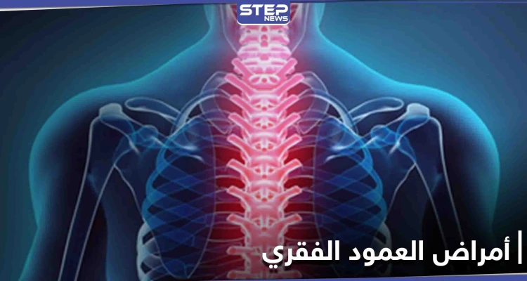 منها السُمنة.. تعرف على أسباب الأمراض التي تصيب العمود الفقري ومدى خطورتها وطرق العلاج