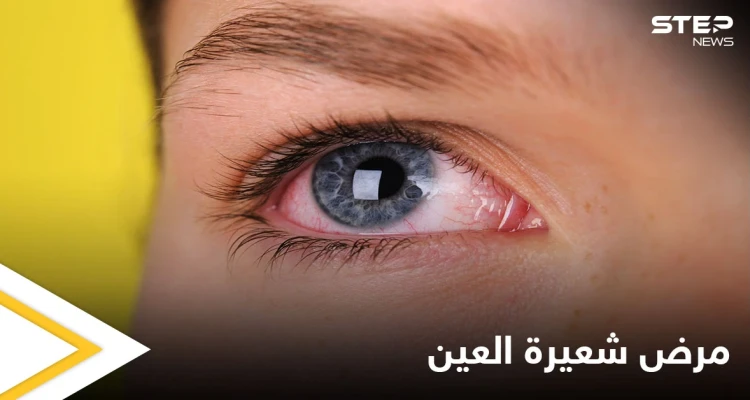 ما هي شعيرة العين وأسباب ظهورها إليك أهم المعلومات