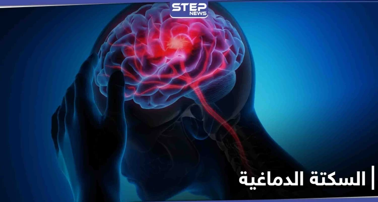 السكتة الدماغية تنهي حياة أعداد كبيرة يومياً.. أعراضها وطرق الوقاية منها
