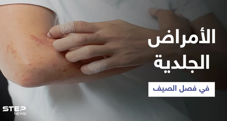 تعرّف على أبرز الأمراض الجلدية الشائعة في فصل الصيف وطرق الوقاية منها