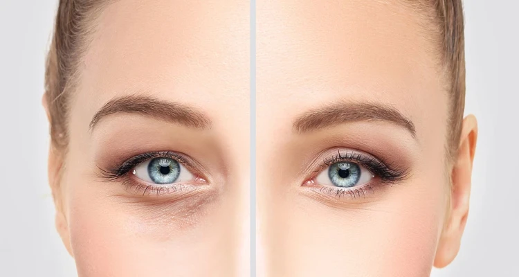 عمليات تجميل العيون .. أنواعها تكلفتها ومخاطرها