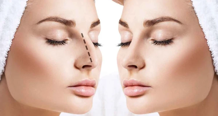 طريقة عملية تجميل الانف وخطوات إجرائها بالتفصيل.. فوائد وأضرار