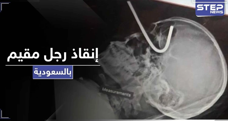 بالصور|| إنقاذ رجل مقيم بالسعودية دخل سيخ تعليق الأضحية بعينه إلى جمجمته