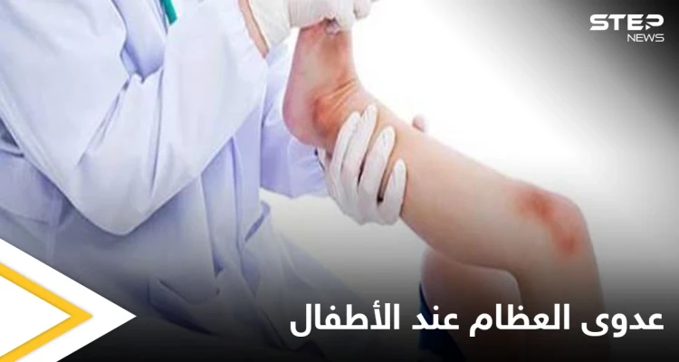 هل تصل الجراثيم إلى العظام وماهي عدوى العظام والمفاصل وخطورتها على الأطفال إليك أهم المعلومات