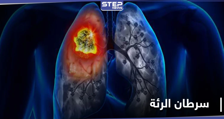 أورام غير متوقعة قد تكون دليلًا على الإصابة بـ سرطان الرئة