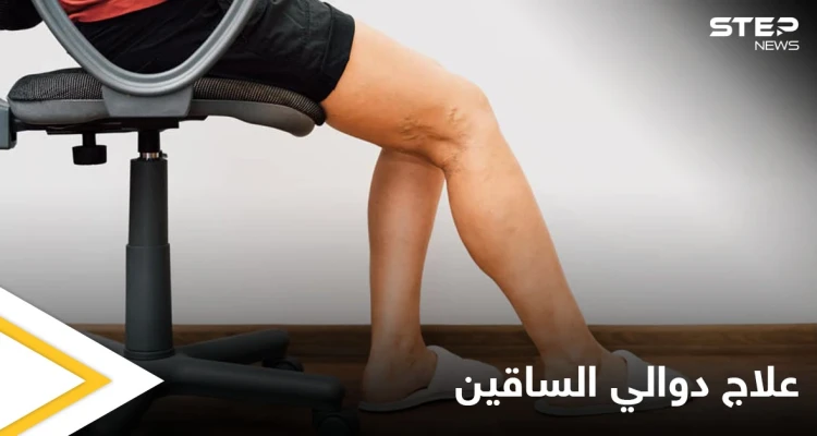 تعرف على أهم الوصفات الطبيعية لعلاج دوالي الساقين