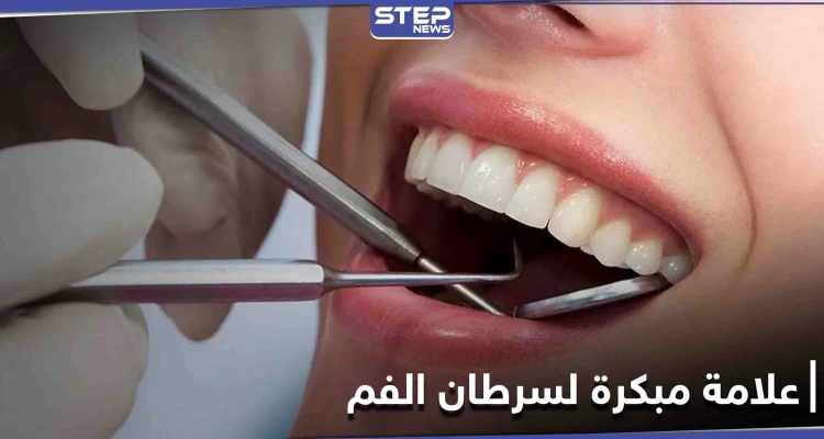 علامة بسيطة على الشفاه غير مبررة قد تكون دليل على الإصابة في سرطان الفم