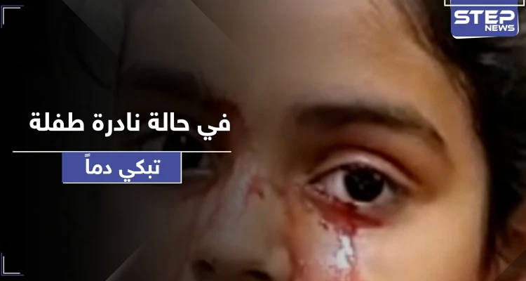 طفلة تبكي دماً بدل الدمع.. حالة طبية نادرة تربك الأطباء وهذه أسبابها