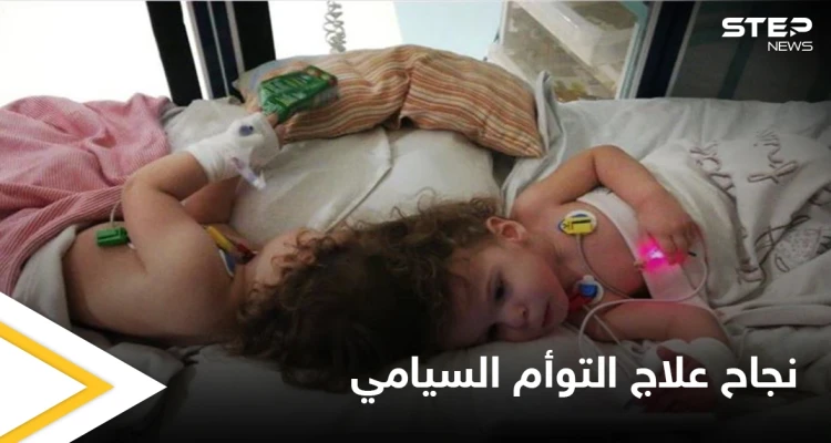 في حالة طبية نادرة.. نجاح علاج التوأم السيامي التركي وقدرتهما على المشي ومصادر تكشف التفاصيل
