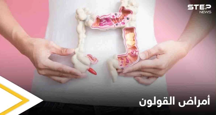 3 أمراض تصيب القولون تعرف على أعراضها وكيفية التفريق بينها