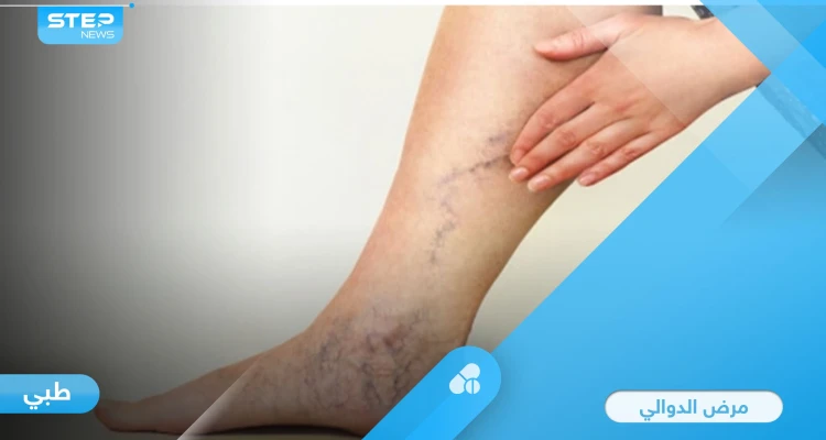 ما هي الدوالي وأسبابها الأعراض الشائعة وطرق علاجها إليك أهم المعلومات