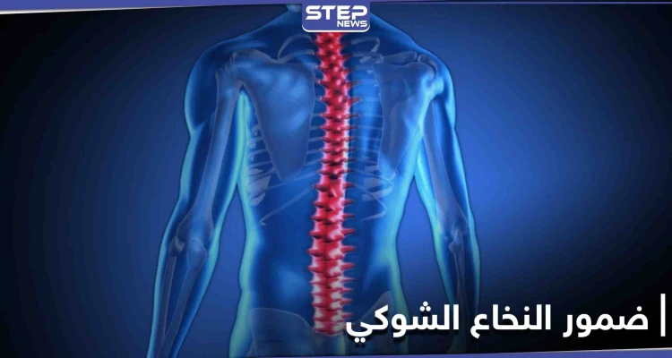 تعرف على مرض ضمور النخاع الشوكي أسبابه ومراحل خطورته على حياة الإنسان