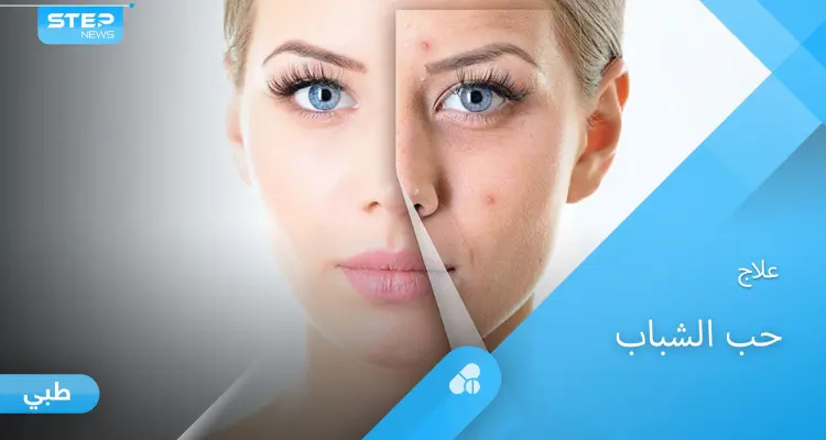 أسباب ظهور حب الشباب وطرق العلاج الفعالة إليك أهم المعلومات: أخبار