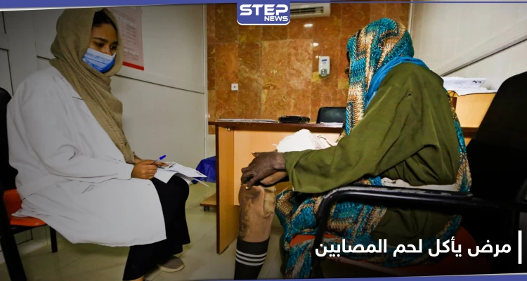 "يأكل لحم المصابين".. مرض المايستوما يتطور خلسة في السودان ويصيب الآلاف