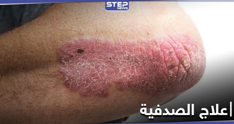 أثر النظام الغذائي على علاج الصدفية.. أنواعها وطرق الوقاية منها