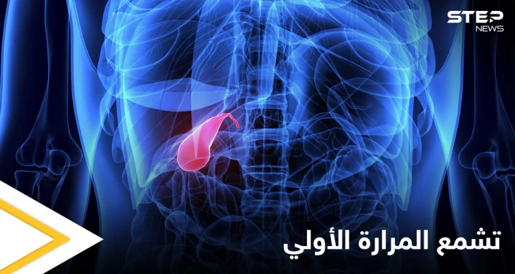 من أخطر الأمراض تشمع المرارة الأولي أسبابه وأعراضه وأهم المعلومات عنه