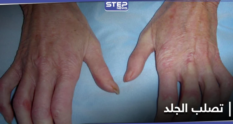 تعرف على مرض تصلب الجلد وآثاره على الأعضاء الداخلية بما فيها الكلى والرئتين