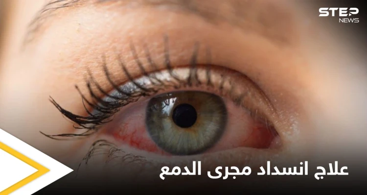 علاج انسداد مجرى الدمع لدى البالغين وأهم المعلومات عنه