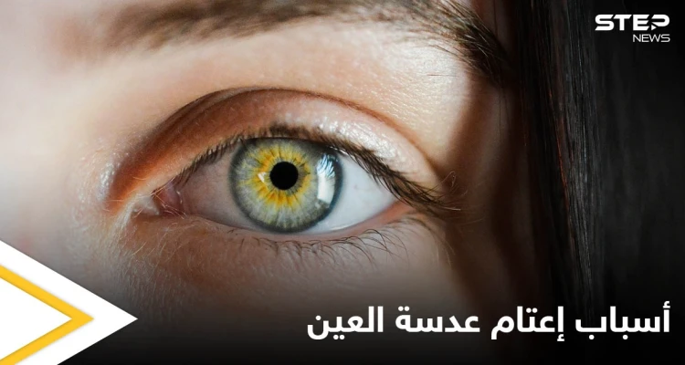 التدخين أحد أسبابه.. إعتام عدسة العين وخطورته وأبرز المسببات لحدوثه إليك اهم المعلومات