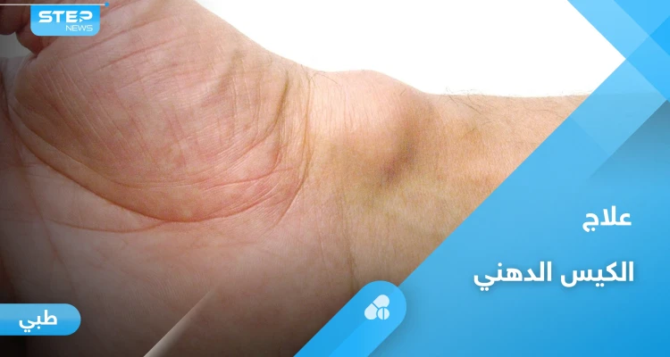 الكيس الدهني.. هل هو خطير وأبرز أعراضه وعلاجه إليك أهم المعلومات
