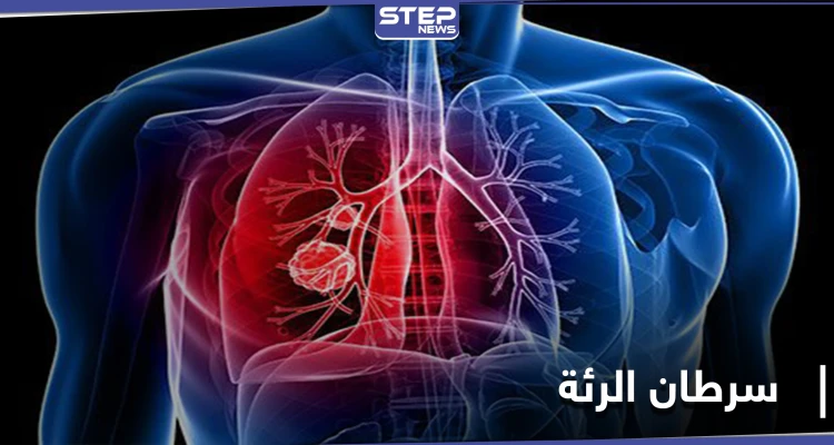علامة تظهر في منطقة العين تدلُّ على الإصابة بـ سرطان الرئة.. إليك التفاصيل