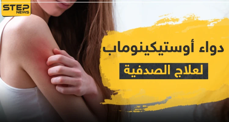 دواء أوستيكينوماب لعلاج الصدفية