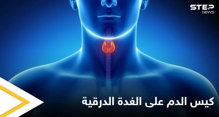 ما هي مخاطر وجود كيس الدم على الغدة الدرقية وأعراضه وطرق العلاج إليك أهم المعلومات