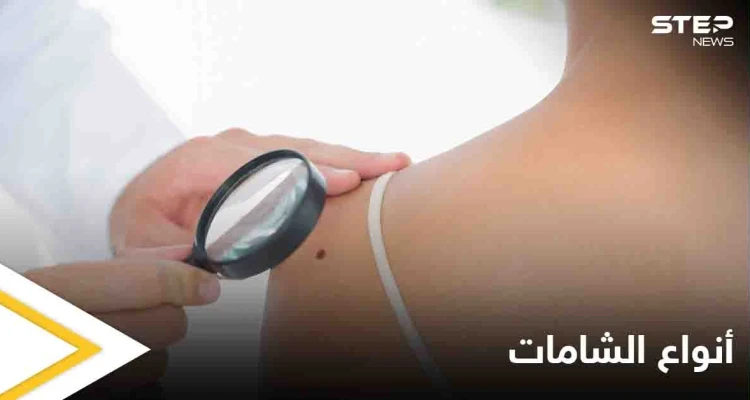 ماهي الشامة وهل لها علاقة بسرطان الجلد تعرف على أنواعها