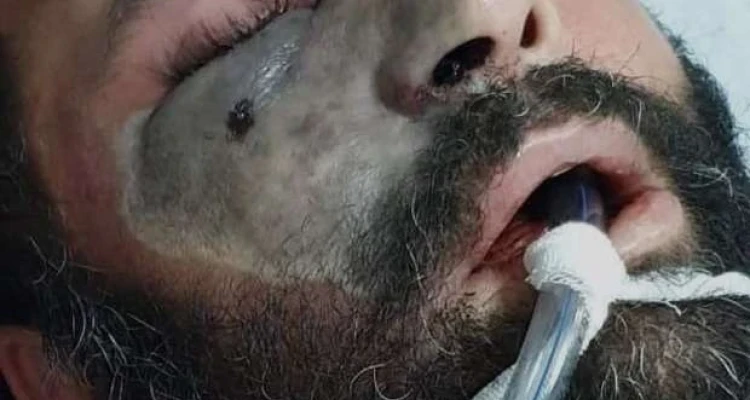 مصر تصدر بياناً بشأن تطورات الإصابة بـ الفطر الأسود.. ورئيس لجنة الصحة يناشد المواطنين