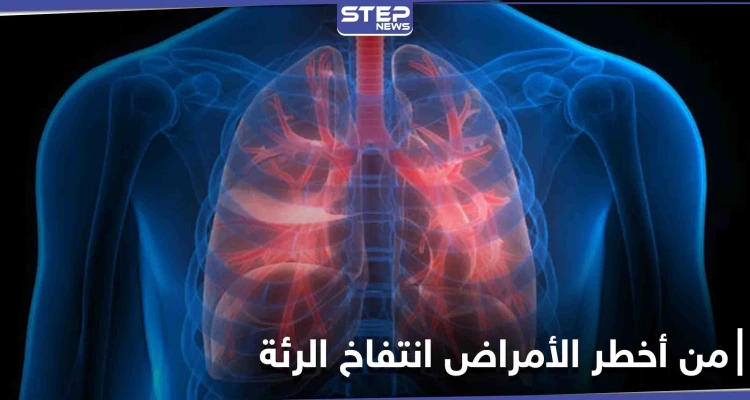 من أعراضه ضيق التنفس والإرهاق المستمر تعرف على مرض انتفاخ الرئة وطرق علاجه