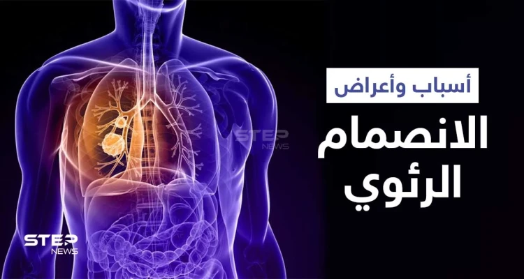 ماهو الانصمام الرئوي ومضاعفاته الخطيرة وعلاقته بالجلطة إليك أهم المعلومات