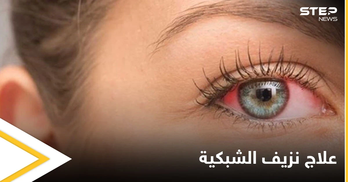 تعرف على علاج نزيف الشبكية بالحقن وطرق أخرى