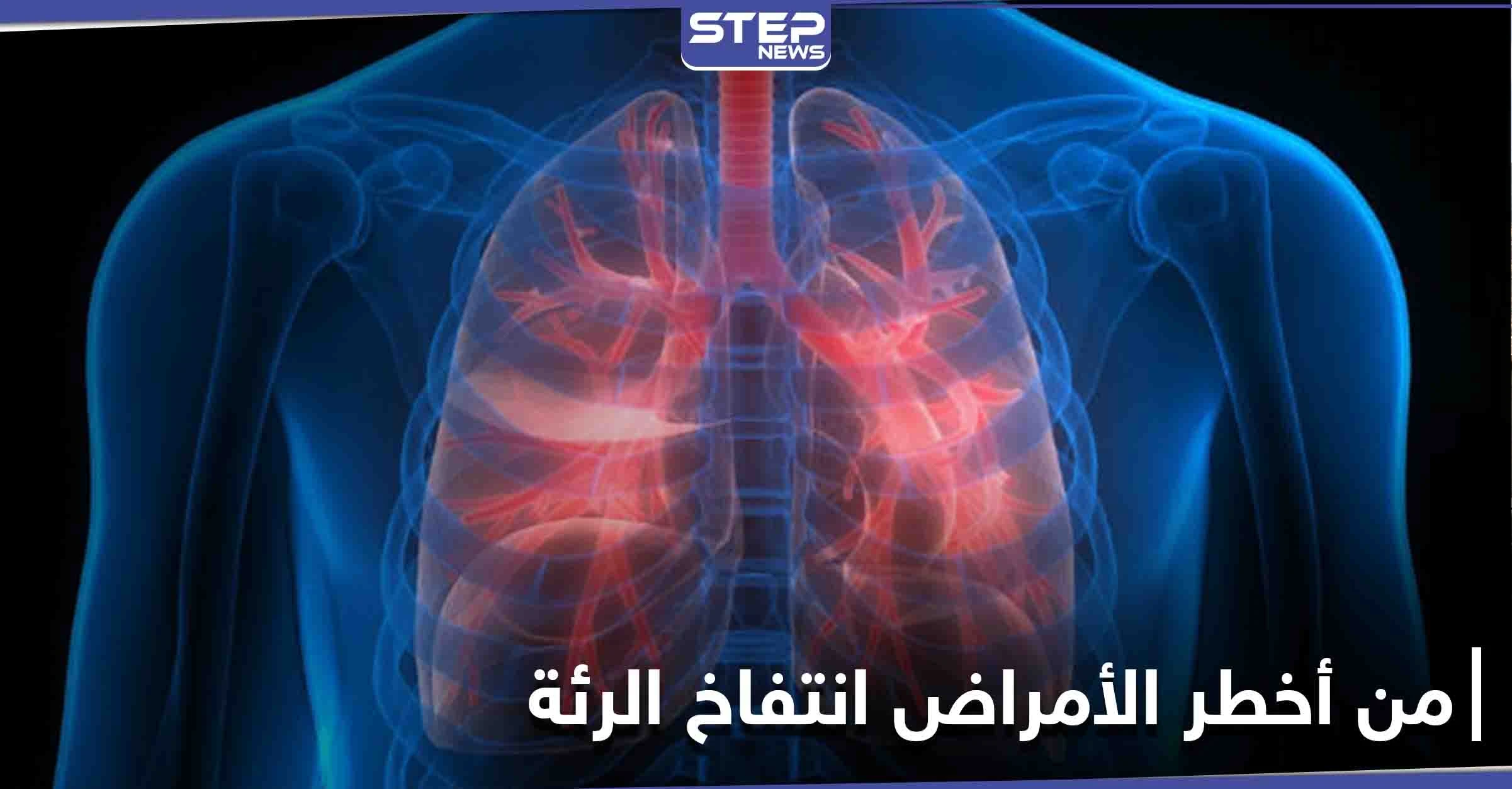من أعراضه ضيق التنفس والإرهاق المستمر تعرف على مرض انتفاخ الرئة وطرق علاجه
