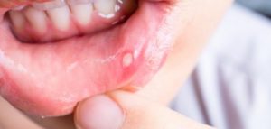 طرق علاج قرحة الفم