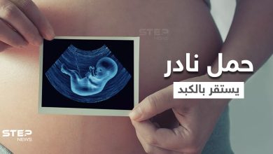 بالفيديو|| بحالة فريدة من نوعها في العالم.. حمل نادر لامرأة خارج الرحم استقر في الكبد