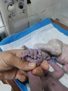 173 170710 rare birth iraq six fingers 3